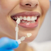 cost-of-porcelain-veneers-1-scaled