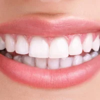 teeth-whitening-after-e1476360472614